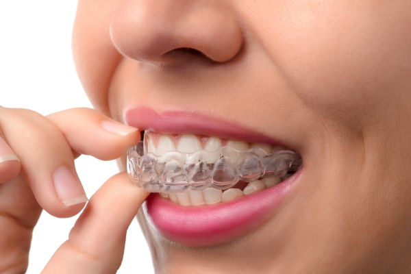 Your Guide to Invisalign for a Confident Smile