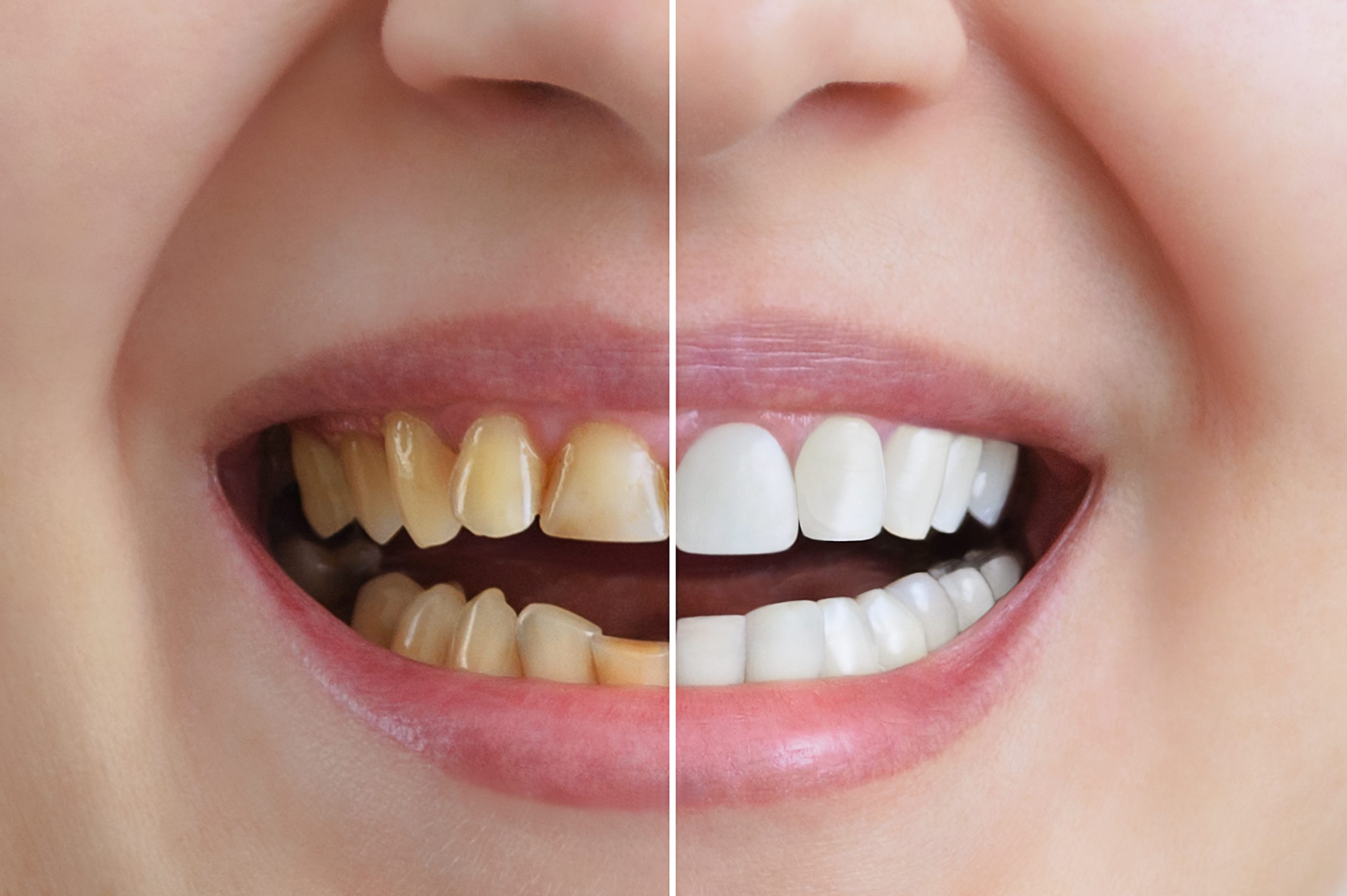 How Long Does It Take To Whiten My Teeth?